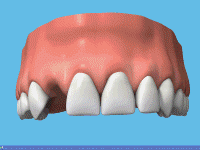 Einsetzung eines Zahnimplantates